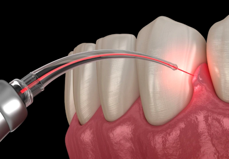 Laser Dentistry