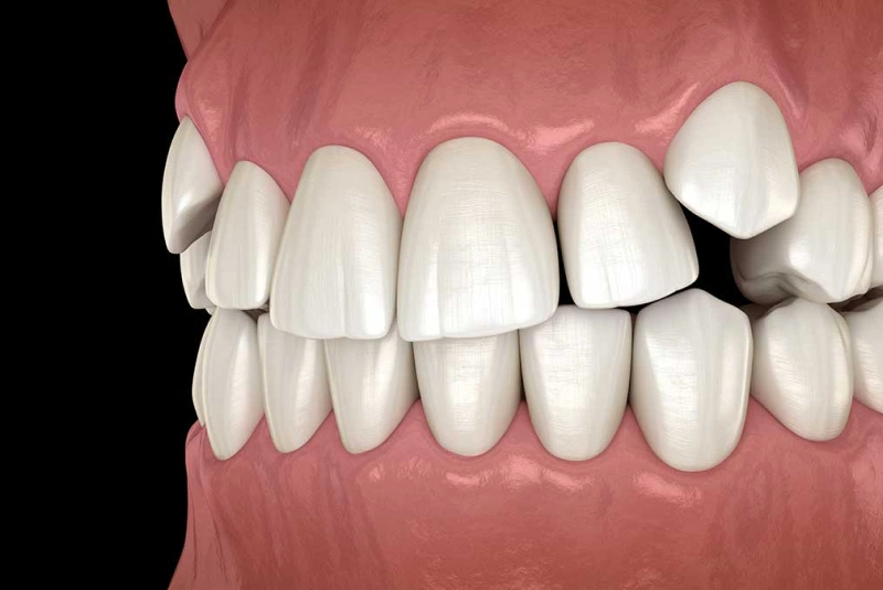 Impacted Canines