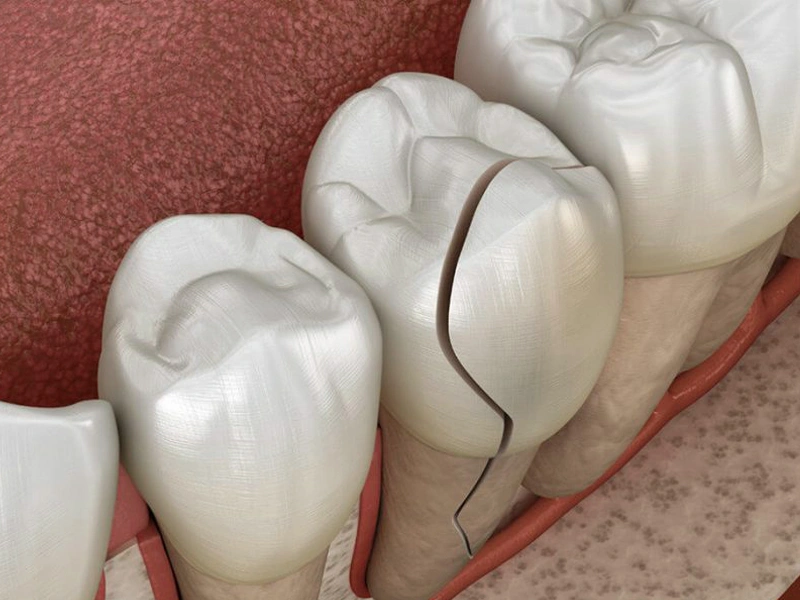 Cracked Tooth