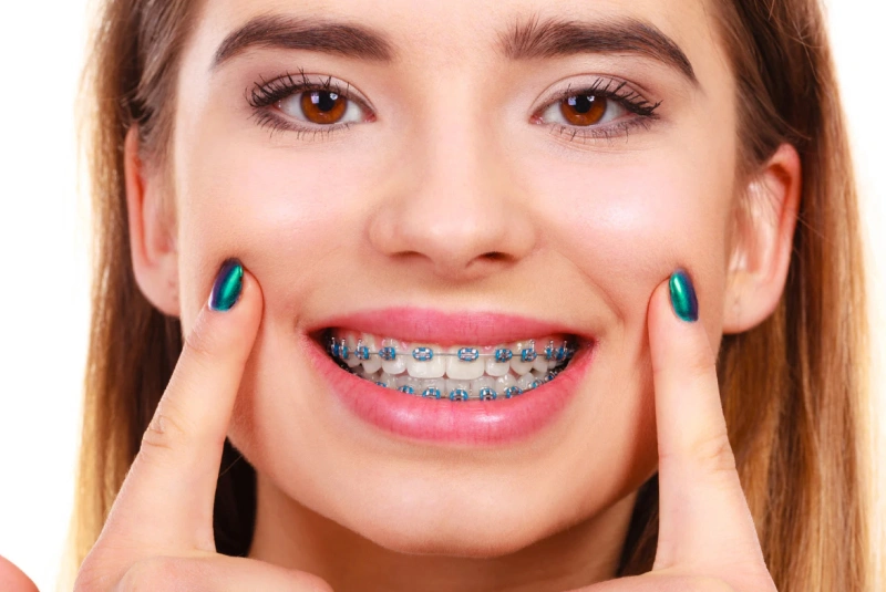 Damon Braces