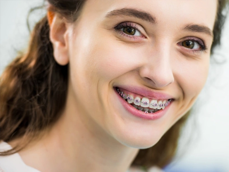 Traditional Braces