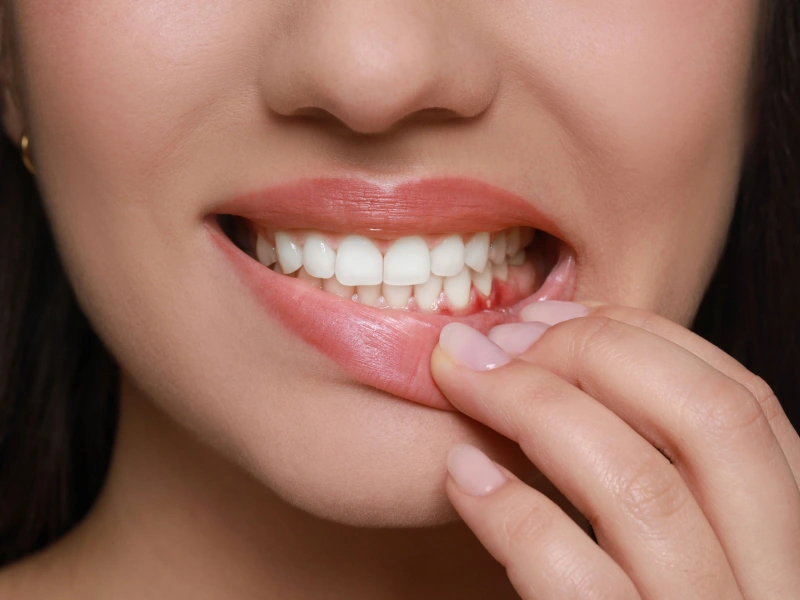 Gum Disease